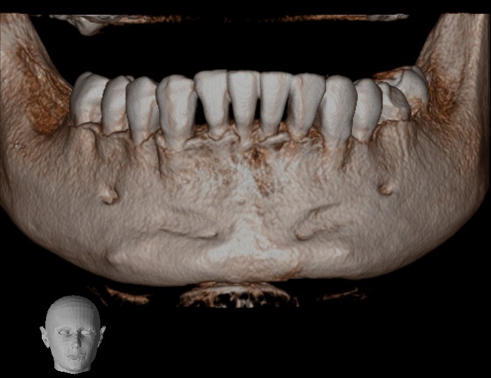 Tomografía dental 3D