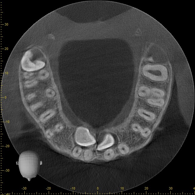 Tomografía CBCT 2